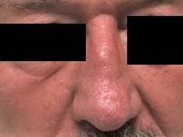 Transposition Flap After