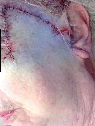 Melanoma Excision *not MOHS* Before