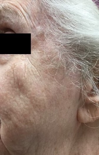 Melanoma Excision *not MOHS* After