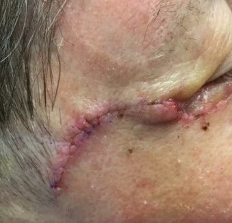 Melanoma Excision *not MOHS* Before