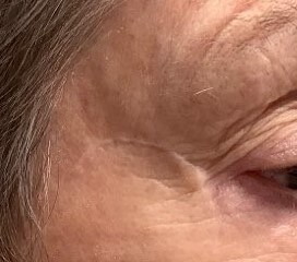 Melanoma Excision *not MOHS* After