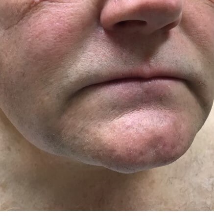 Advancement Flap After