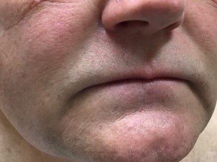 Advancement Flap After