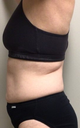 truSculpt iD 2 After