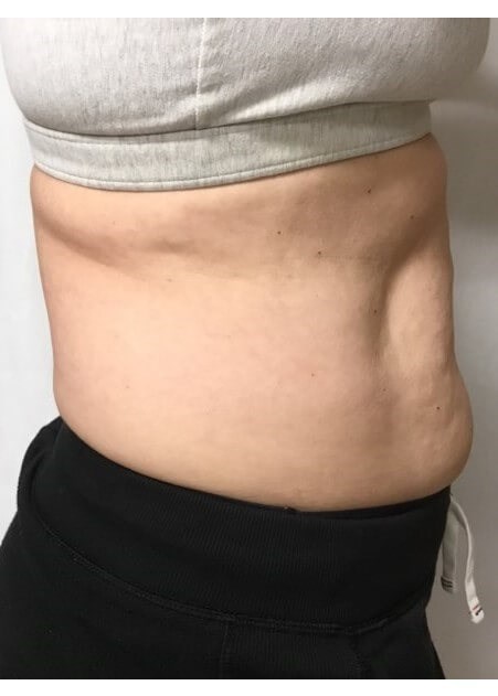 truSculpt iD 2 Before