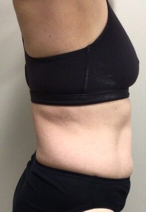 truSculpt iD 2 After