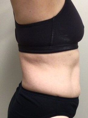 truSculpt iD 2 After