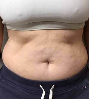 truSculpt iD 2 Before