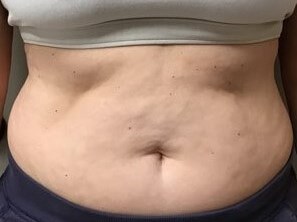truSculpt iD 2 Before