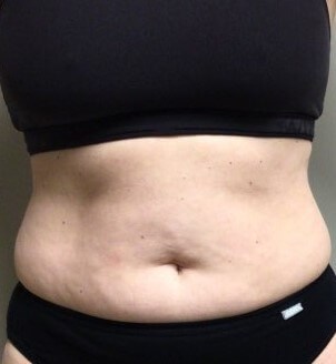 truSculpt iD 2 After