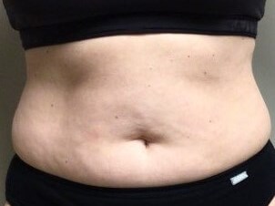 truSculpt iD 2 After