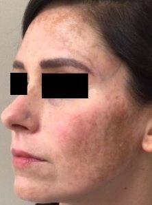 Chemical Peel 3 Before