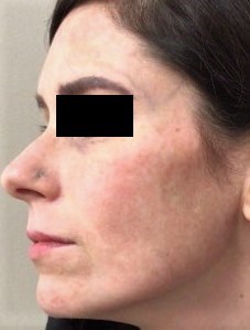 Chemical Peel 3 After