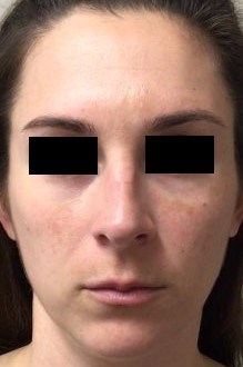 Chemical Peel 3 After