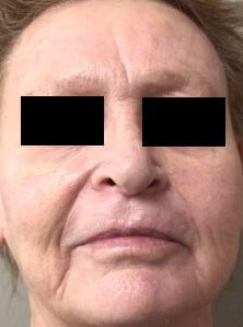 Chemical Peel 3 Front After