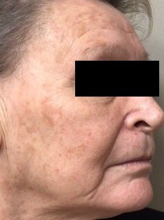 Chemical Peel 3 Side Before