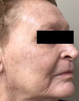 Chemical Peel 3 Side After