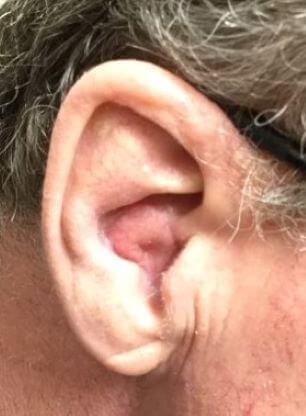 Interpolation Flap After