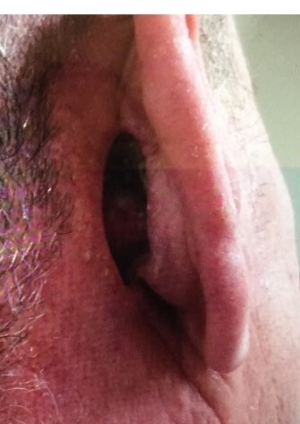 Interpolation Flap Before
