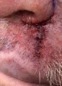 O-T Advancement Flap Before