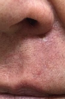 O-T Advancement Flap After