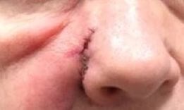 Transposition Flap Before