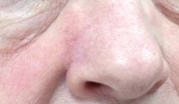 Transposition Flap After