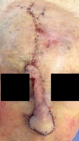 Paramedian Forehead Flap Before