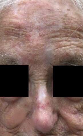 Paramedian Forehead Flap After