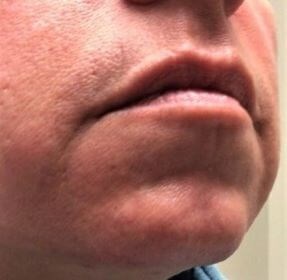 Laser Hair Removal After