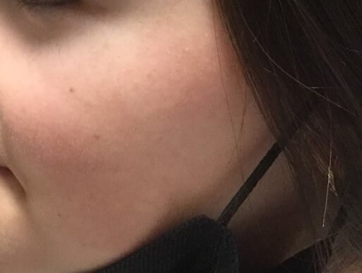 Keratosis Pilaris After