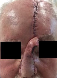 Paramedian Forehead Flap Before