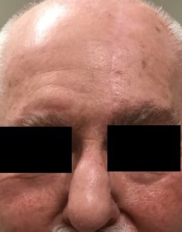 Paramedian Forehead Flap After