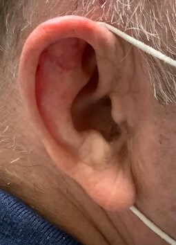 Surgical Graft After