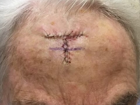 O-T Advancement Flap Before