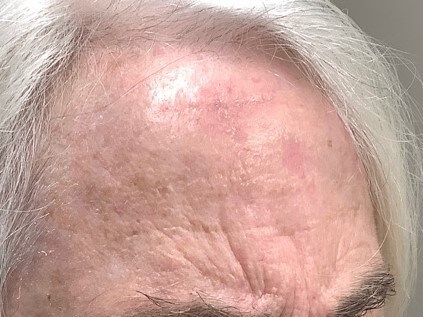 O-T Advancement Flap After