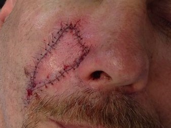 V-Y Flap Before