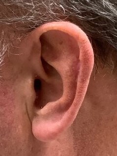 Skin Graft Surgical Repair After